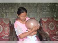 Bocah Penderita Hydrocepalus di Tuban Butuh Pertolongan