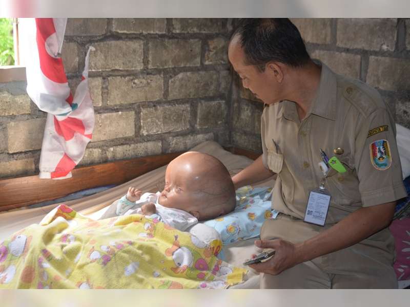 Dinkes Beri Perhatian Terhadap Bocah Penderita Hydrocepalus