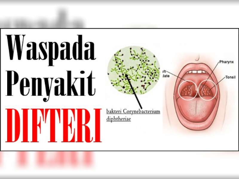 Bojonegoro Ditetapkan KLB Kasus Penyakit Difteri