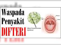 Bojonegoro Ditetapkan KLB Kasus Penyakit Difteri