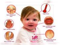 Kawasaki, Penyakit Baru dari Jepang Perlu Diwaspadai