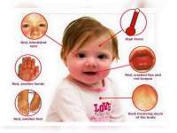 Dinkes Bojonegoro Masih Tunggu Instruksi Provinsi Terkait Kawasaki