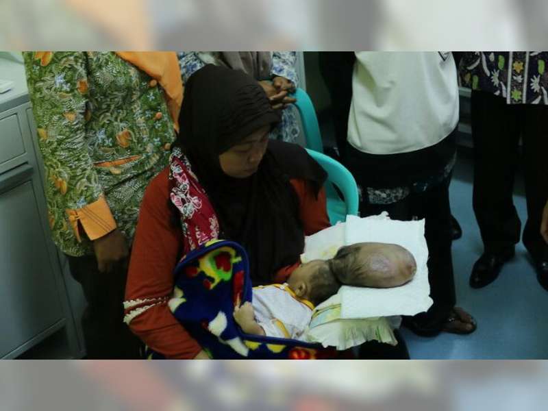 Maulana, Penderita Meningoencephalocele Sudah Dirawat di RS Dokter Soetomo Surabaya