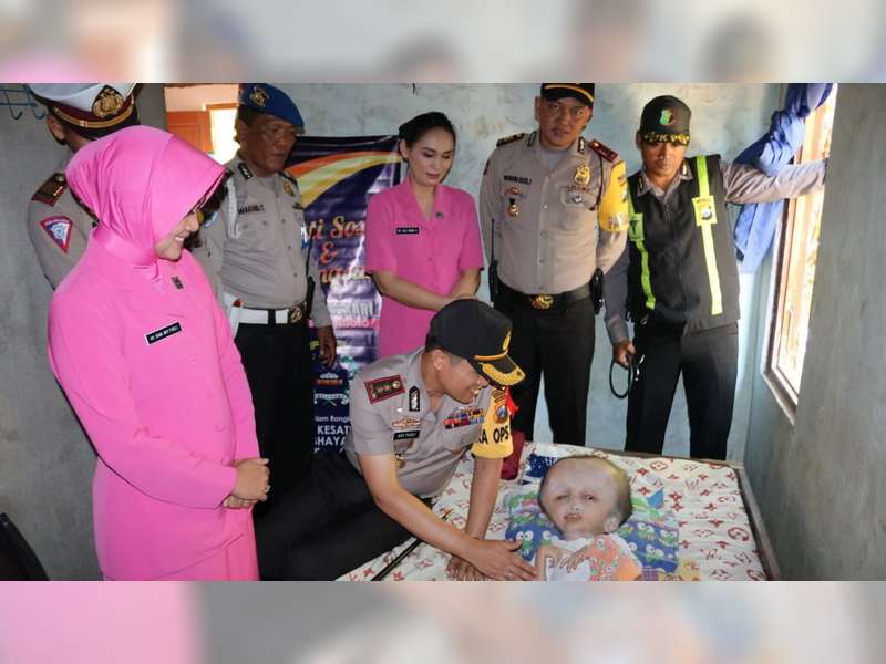 Kapolres Bojonegoro Kunjungi Anak Penderita Hidrosefalus