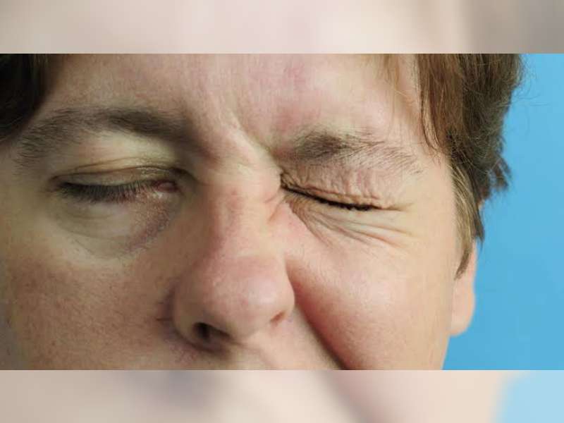 Bell's Palsy, Kelumpuhan Sementara Syaraf di Wajah yang Bikin Tidak Nyaman