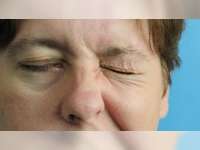 Bell's Palsy, Kelumpuhan Sementara Syaraf di Wajah yang Bikin Tidak Nyaman