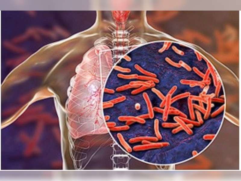 TBC Masih Jadi Ancaman Serius di Bojonegoro, Dinkes Tekankan Pentingnya Deteksi Dini