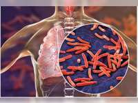 TBC Masih Jadi Ancaman Serius di Bojonegoro, Dinkes Tekankan Pentingnya Deteksi Dini