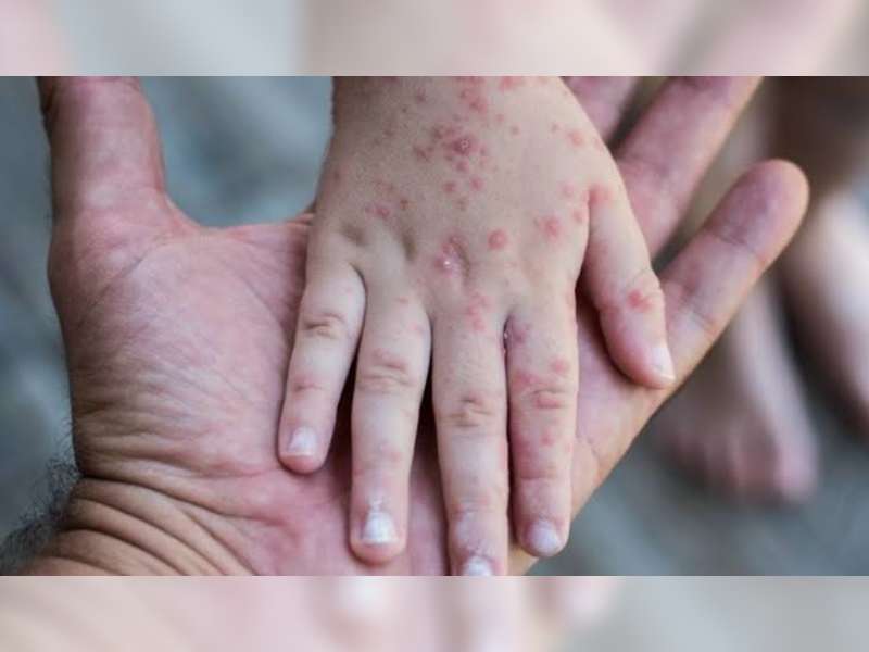 Waspada Penularan Campak pada Anak, Tenaga Medis Ingatkan Risiko Komplikasi Hingga Peradangan Otak