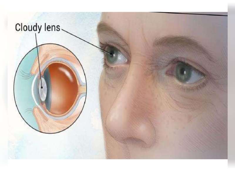 Sering Gonta-ganti Ukuran Lensa Kacamata? Waspadai Gejala Katarak Sejak Dini