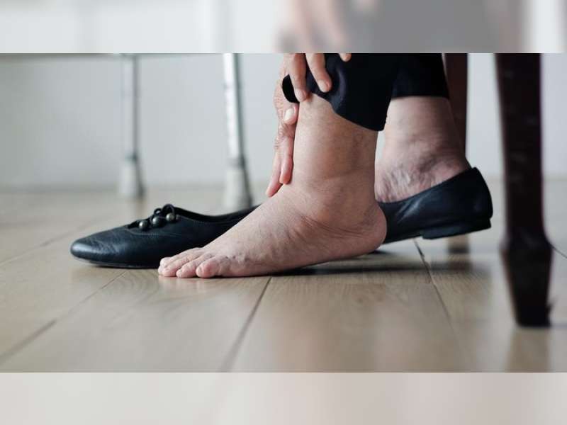 Jangan Sepelekan Perubahan pada Kaki, Bisa Jadi Tanda Awal Kerusakan Ginjal